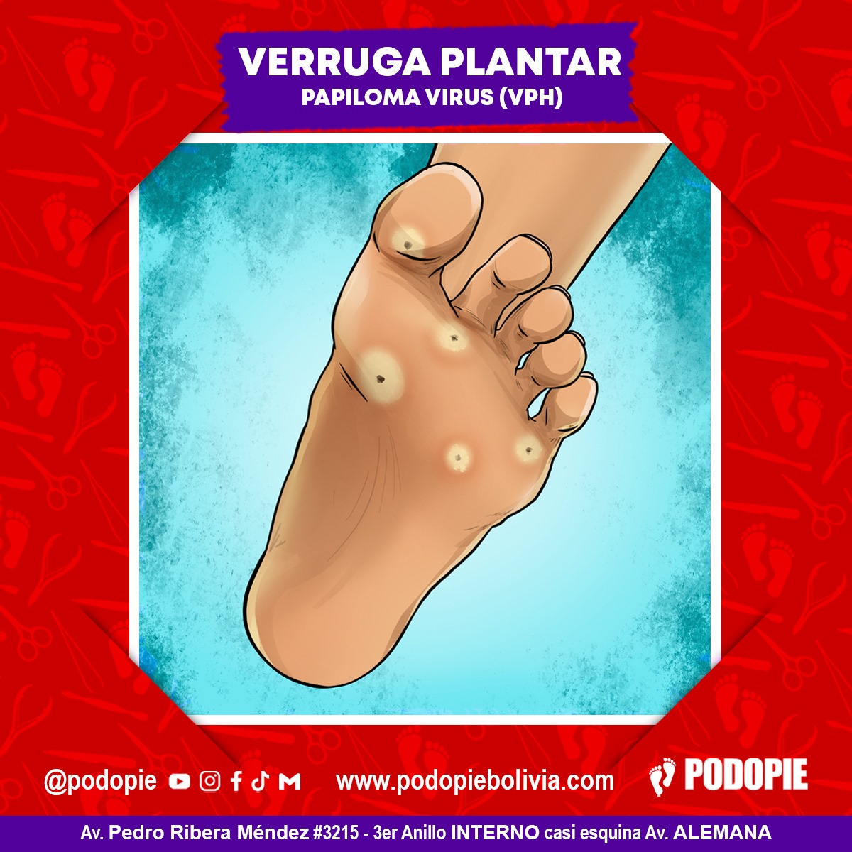 10. VERRUGA PLANTAR