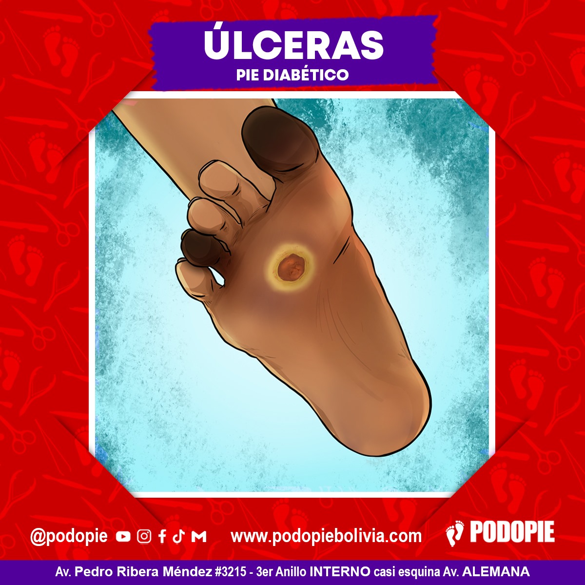 16. ULCERAS