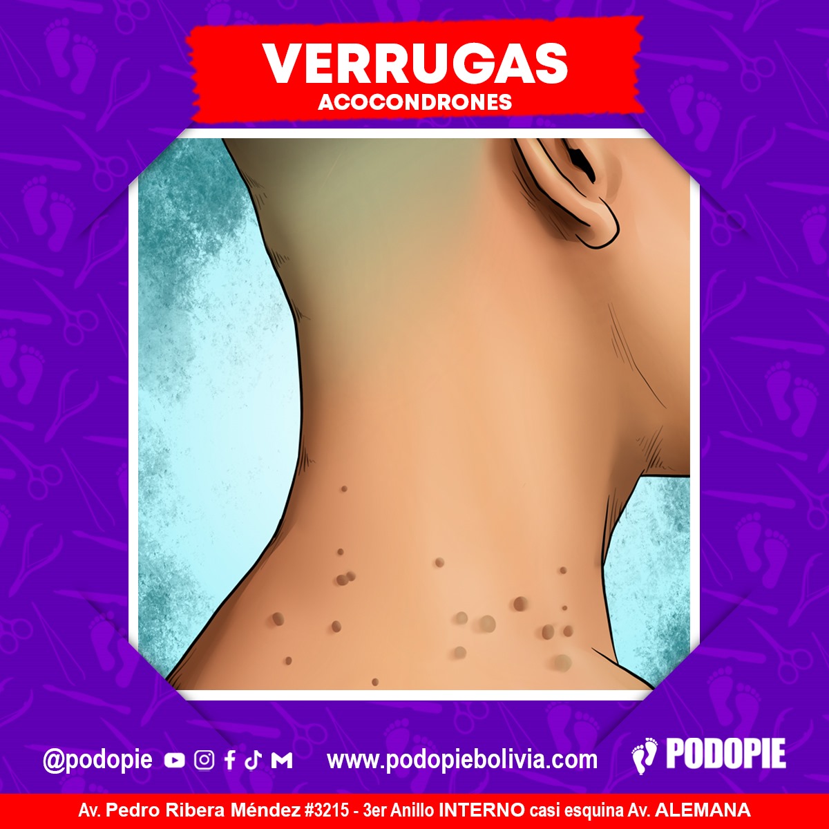 17. VERRUGAS ACOCONDRONES